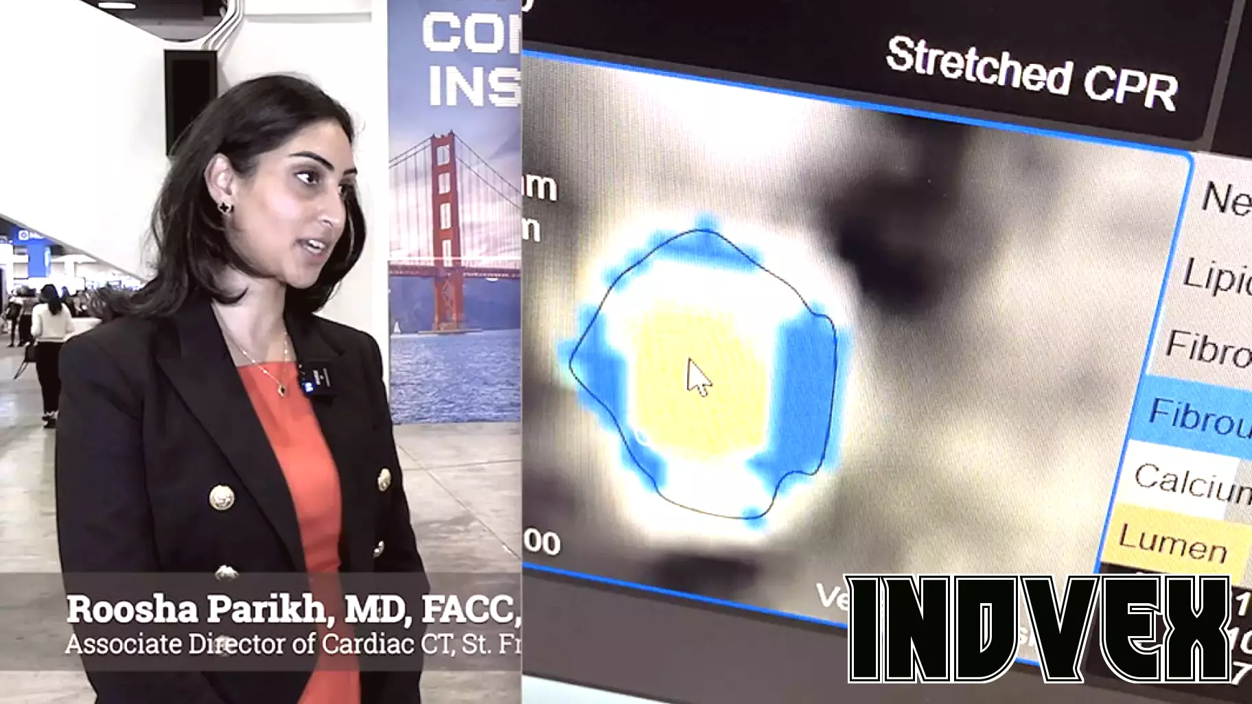 Advancements in Coverage for AI-Driven Plaque Assessments