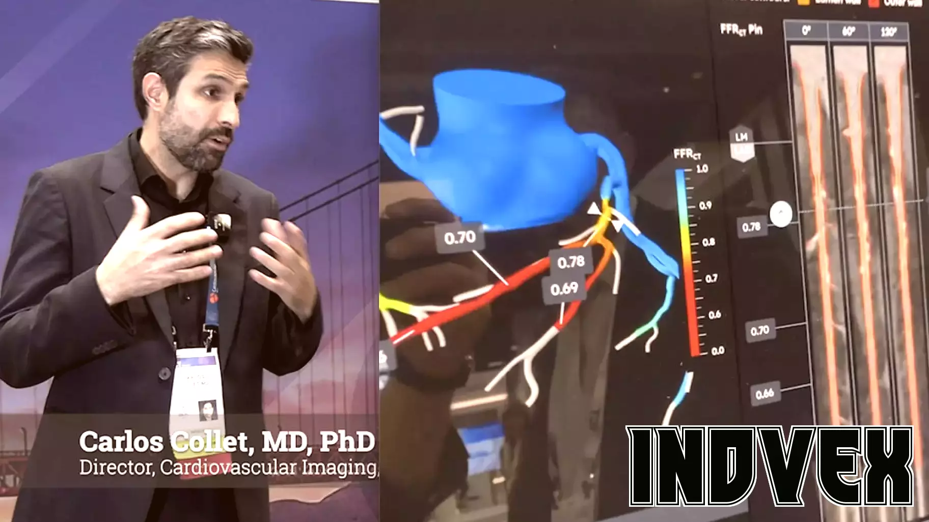 The Future of Cardiac Care: The Rise of Noninvasive Coronary CT Angiography